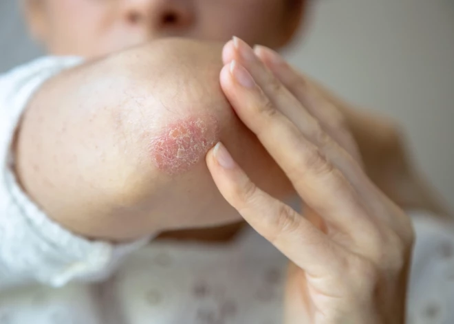 Rīgas 1. slimnīcā iespējams saņemt bezmaksas psoriāzes diagnostiku