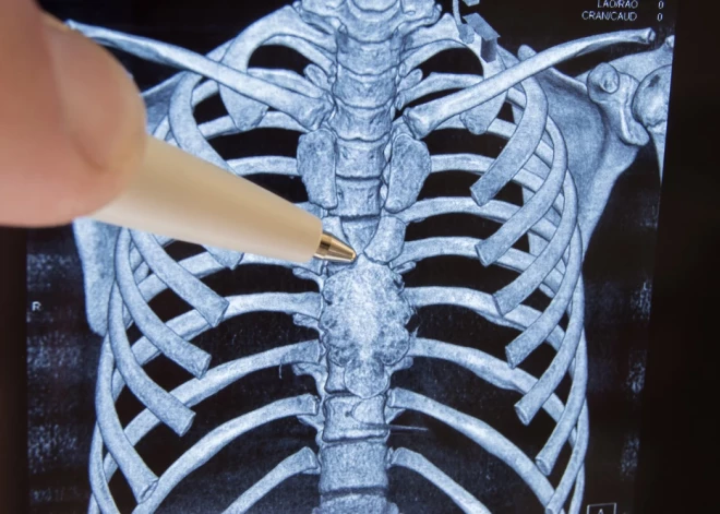 Vēža profilaksē svarīgi, lai strādātu aizkrūtes dziedzeris