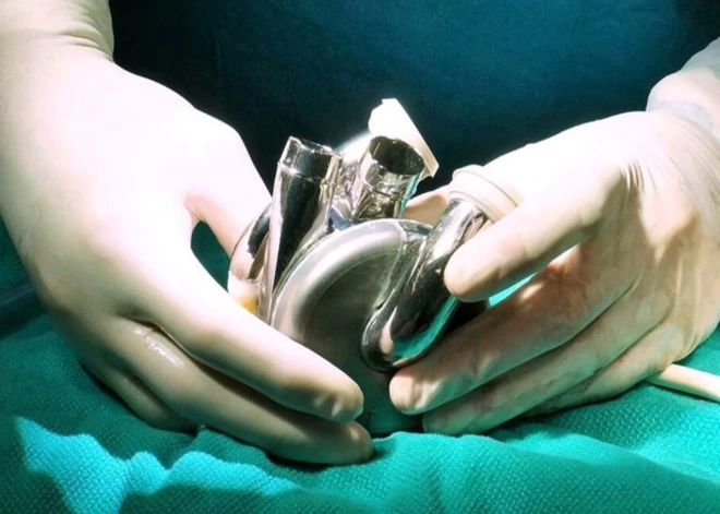 Vīrietis ar titāna sirdi krūtīs nodzīvo vairāk nekā 100 dienu un sagaida transplantāciju