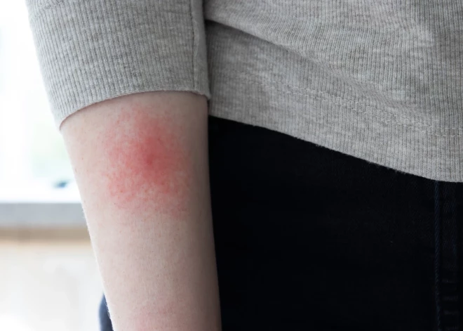 Kā pamanīt un neielaist Laimas slimību? Infektologs Māris Liepiņš izskaidro pazīmes