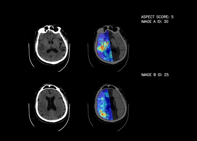 Mākslīgais intelekts atpazīst insultu ar 93% precizitāti. Profesors Kupčs: "Esam pārsteigti"