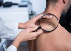Dermatoloģe iesaka, kā vislabāk pārbaudīt un atpazīt aizdomīgas dzimumzīmes