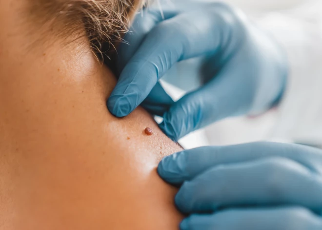 Береги свою кожу: сегодня в центре Риги проходит бесплатная проверка родинок