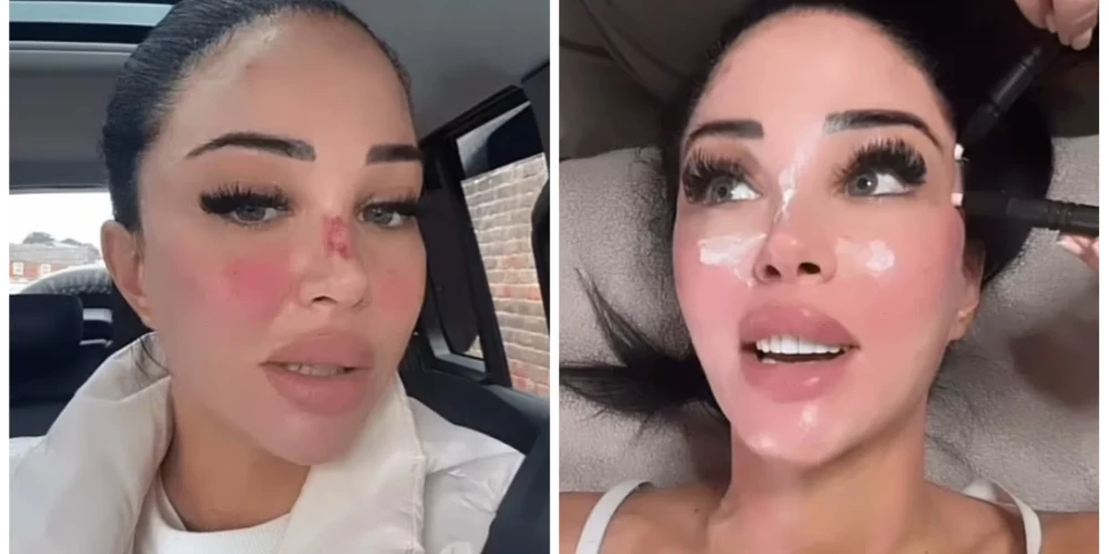 Britu dziedātāja Tulisa pēc skaistumkopšanas procedūrām.