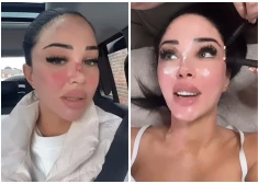 Britu dziedātāja Tulisa lepni parāda asiņaino degunu un pietūkušo seju pēc sešu skaistumkopšanas procedūru kursa