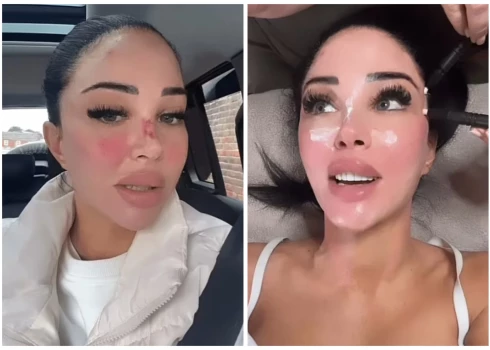 Britu dziedātāja Tulisa pēc skaistumkopšanas procedūrām.