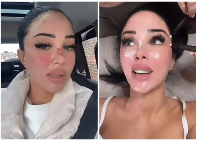 Britu dziedātāja Tulisa lepni parāda asiņaino degunu un pietūkušo seju pēc sešu skaistumkopšanas procedūru kursa