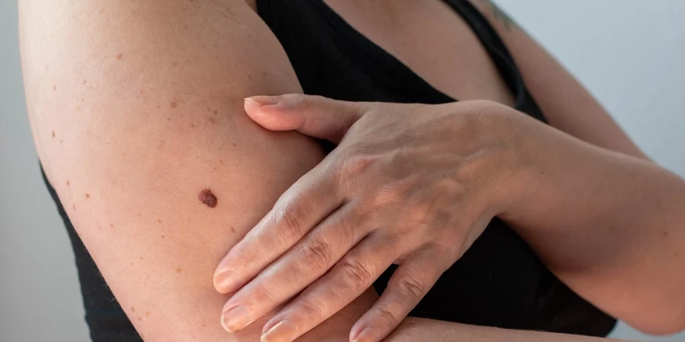 Aptuveni 80% melanomu rodas kā jauns veidojums, nevis no esošām dzimumzīmēm.