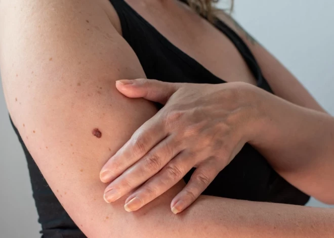 Kas jāzina par dzimumzīmēm un ādas vēzi: atbild dermatologs