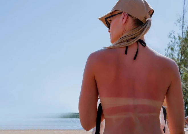 Saules apdegums 10 minūtēs - milzīgas problēmas uz visu mūžu. Vai tiešām tas ir tā vērts?