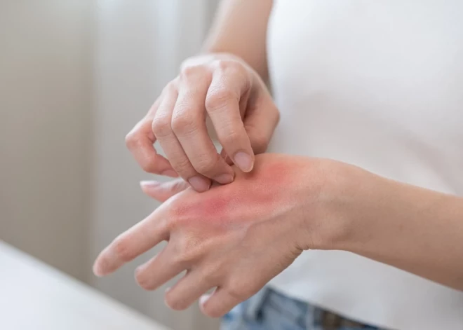 Первые симптомы дерматита: что важно знать и как действовать