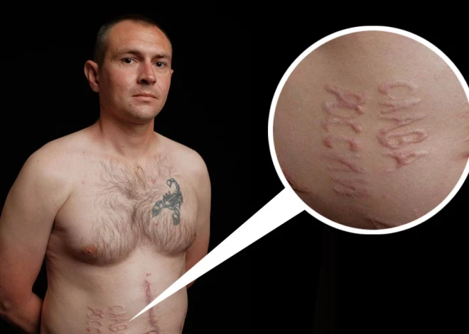 Okupantu ķirurga sakropļotais Ukrainas aizstāvis vēlas atgriezties frontē