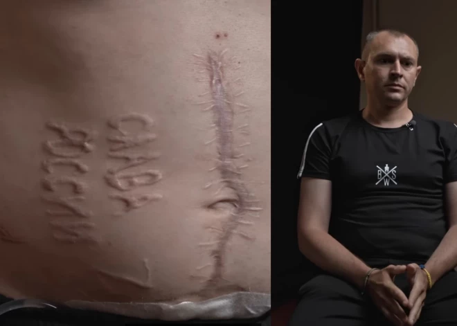 Изуродованный российским хирургом защитник Украины хочет вернуться на фронт