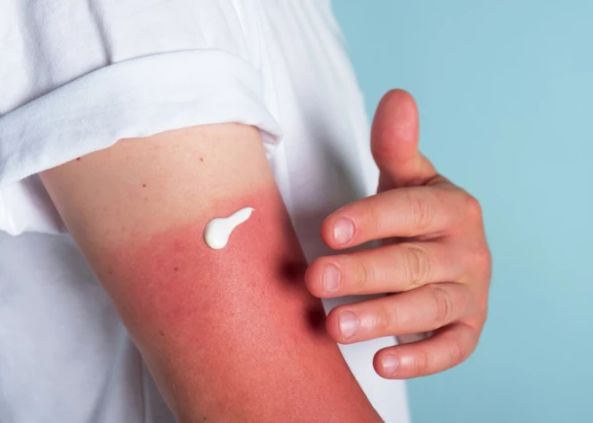 Осторожно, ультрафиолет! Что нужно знать латвийцам перед выходом на улицу в солнечные дни