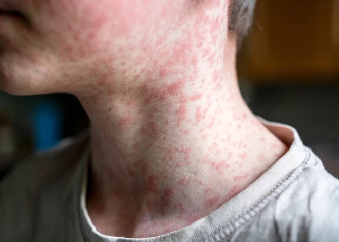 Eiropā izplatās ļoti bīstama slimība; ceļotājus aicina uzmanīties, lai to neievazātu Latvijā