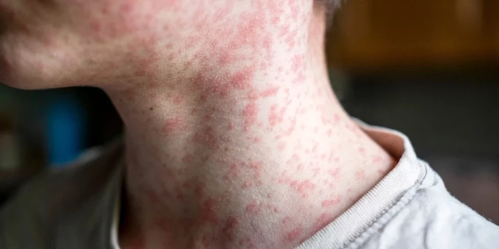 Заболевший корью.