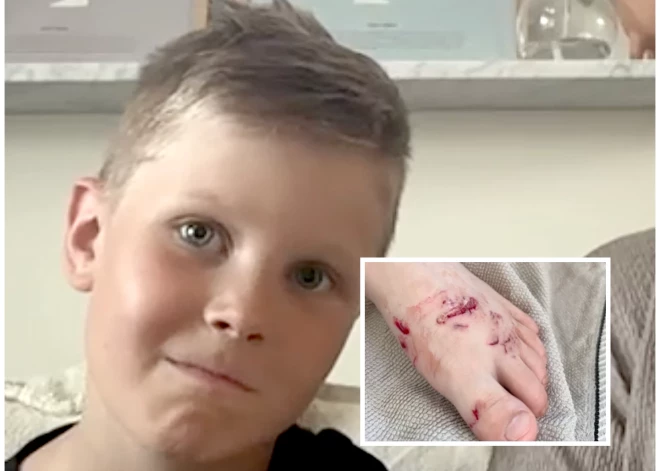Līdaka Zviedrijā uzbrukusi 8 gadus vecam zēnam. "Vairākas brūces bija ļoti dziļas!"