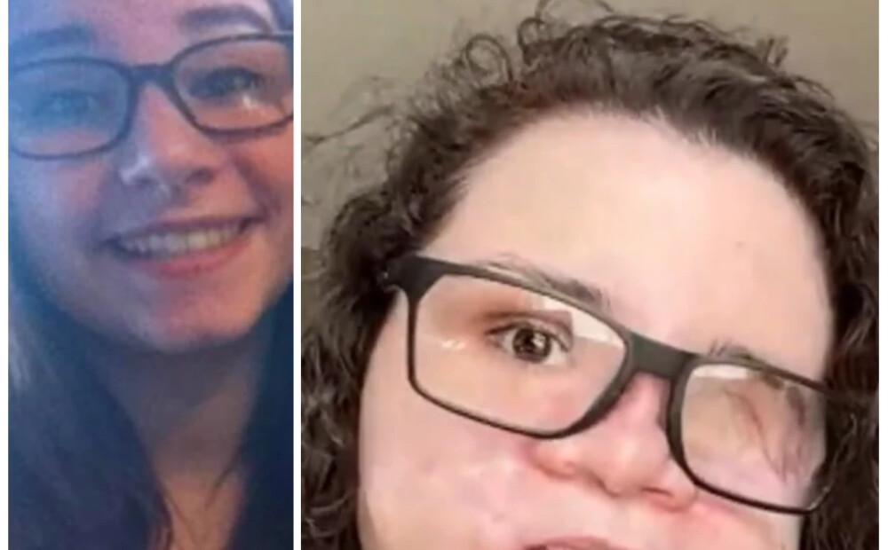 "Gribi redzēt, kāds es traks?" teica patēvs un nošāva 18 gadus vecās Amedijas mammu un iešāva viņai sejā. Tagad sieviete atgūst spēku dzīvot un palīdzēt citiem vardarbības upuriem