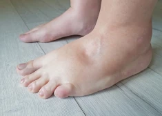 Karstumā pietūkušas kājas – tā ir norma vai brīdinājuma signāls?