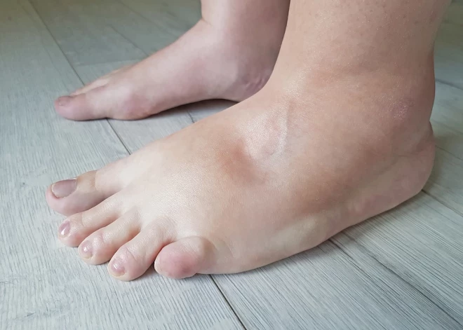 Karstumā pietūkušas kājas – tā ir norma vai brīdinājuma signāls?