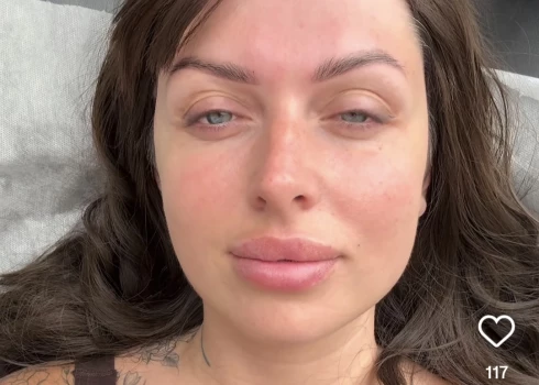 Elīna Gluzunova bez viebšanās pacieš adatu dūrienus botulīntoksīna ievadīšanas procedūras laikā. Un dziedātāja atzīst, ka injekciju rezultātu dievina.