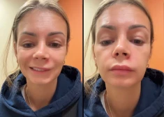 Женщина попала в больницу после выдавливания прыща в "треугольнике смерти" на лице
