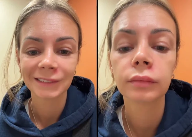 Женщина попала в больницу после выдавливания прыща в "треугольнике смерти" на лице