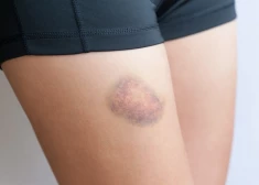 Uz ķermeņa bieži uzrodas zilumi. Ko tas signalizē par veselību?