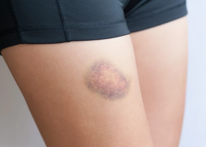 Uz ķermeņa bieži uzrodas zilumi. Ko tas signalizē par veselību?