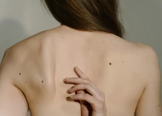 Zinātnieki atklājuši bīstamu saikni starp dzimumzīmēm uz labās rokas un vēzi