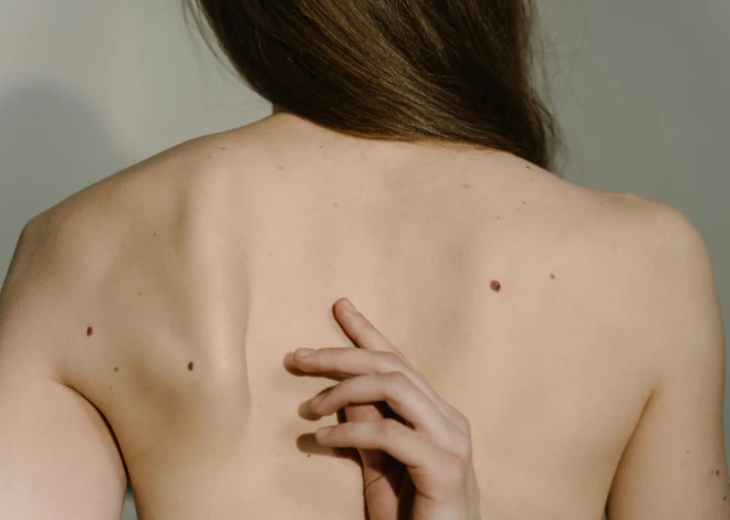 Zinātnieki atklājuši bīstamu saikni starp dzimumzīmēm uz labās rokas un vēzi