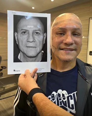 Veronikas onkulis Harijas pirms un pēc plastiskās ķirurģijas.