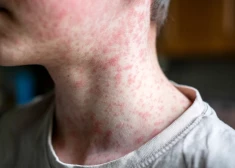 В Эстонии растет число случаев опасного заболевания - кори. Государство заявляет об утрате коллективного иммунитета