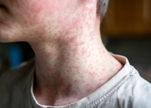 Заболевший корью человек.