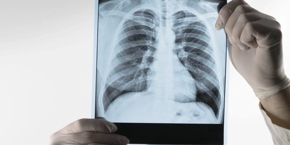 Болезни легких - третья причина смерти в Латвии.