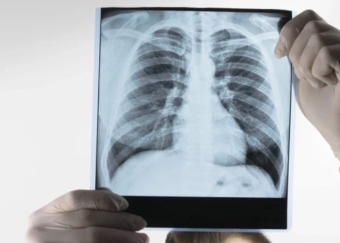 Болезни легких - третья причина смерти в Латвии.