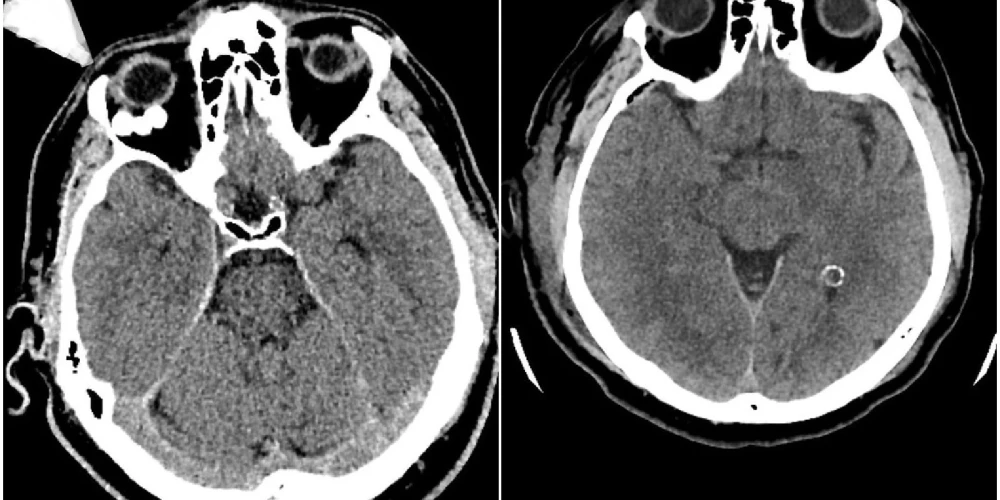 Stradiņa slimnīcā veikta unikāla neiroķirurģiska operācija – caur galvaskausu izoperēts audzējs acs dobumā aiz acs ābola.