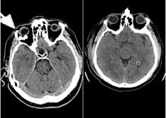 Stradiņa slimnīcā veikta unikāla neiroķirurģiska operācija – caur galvaskausu izoperēts audzējs acs dobumā aiz acs ābola