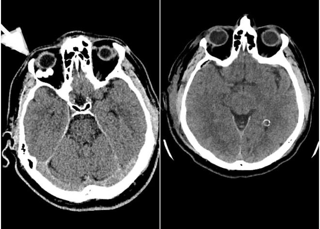 Stradiņa slimnīcā veikta unikāla neiroķirurģiska operācija – caur galvaskausu izoperēts audzējs acs dobumā aiz acs ābola
