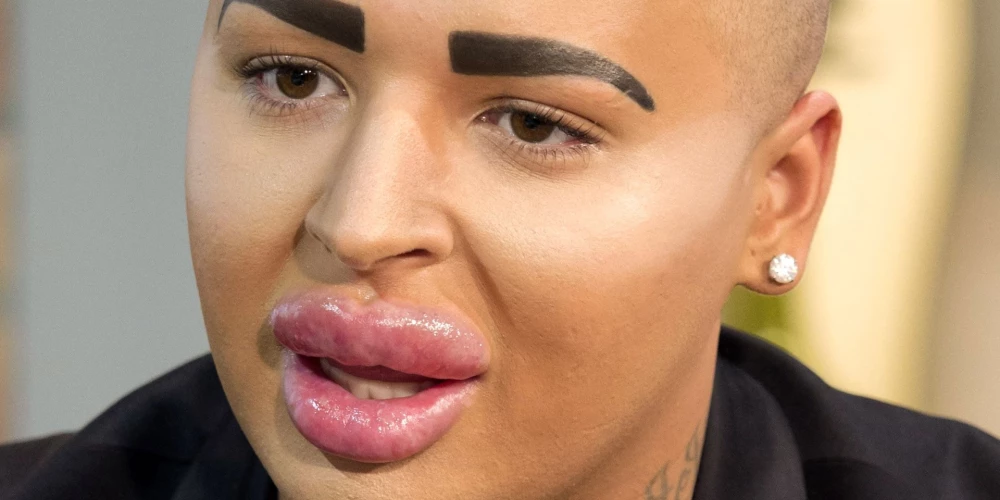 Džordans Džeimss Pārks, kurš sevi dēvēja par Lūpu karali, bija apsēsts ar plastiskajām operācijām un centās līdzināties realitātes TV zvaigznei Kimai Kardašjanai.