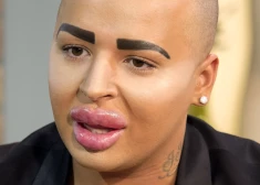 34 gadu vecumā pēkšņi miris vīrietis, kurš ar plastiskās ķirurģijas palīdzību centās līdzināties Kimai Kardašjanai