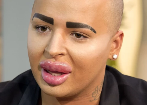 Džordans Džeimss Pārks, kurš sevi dēvēja par Lūpu karali, bija apsēsts ar plastiskajām operācijām un centās līdzināties realitātes TV zvaigznei Kimai Kardašjanai.