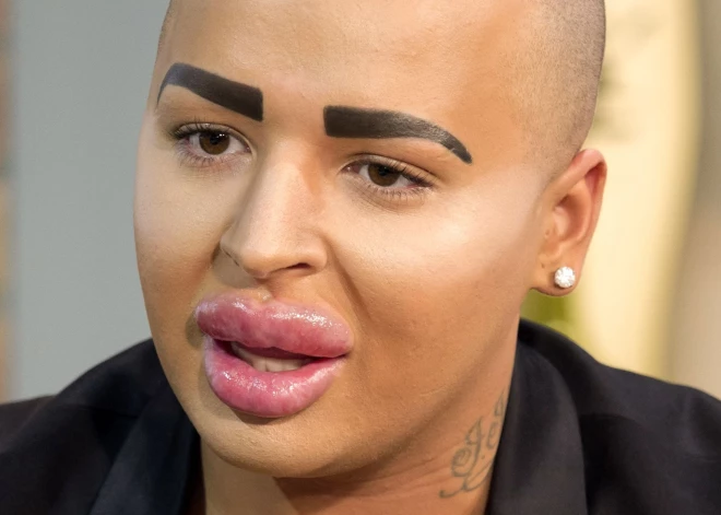 34 gadu vecumā pēkšņi miris vīrietis, kurš ar plastiskās ķirurģijas palīdzību centās līdzināties Kimai Kardašjanai