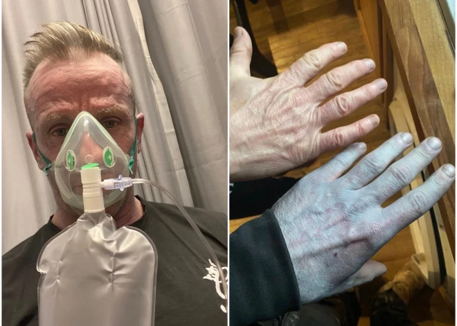 Lielbritānijā vīrietis pamostas zils kā Avatars — patiesais iemesls sasmīdina ārstus