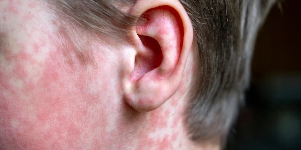 Эпидемиологи просят срочно связаться всех, кто мог быть рядом с заболевшим.