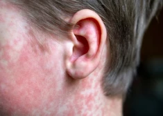 Подтвержденный случай кори в Риге: ищут всех возможных контактных лиц