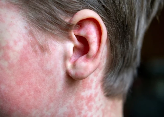 Подтвержденный случай кори в Риге: ищут всех возможных контактных лиц