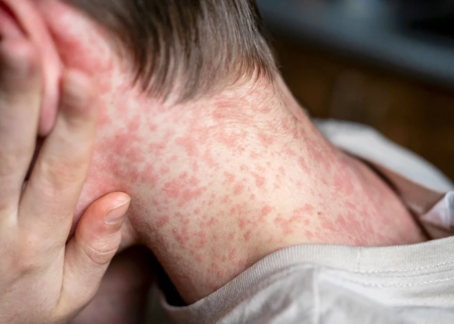 Masalu draudi: trīs pasākuma "Ļutaurus viktorīna" dalībnieki sazinājušies ar Slimību profilakses un kontroles centru