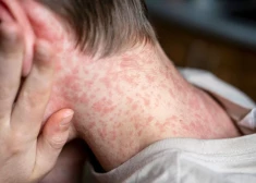 Угроза распространения кори после мероприятия в Риге: в SPKC обратились три человека