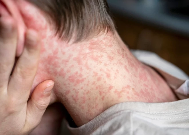 Угроза распространения кори после мероприятия в Риге: в SPKC обратились три человека